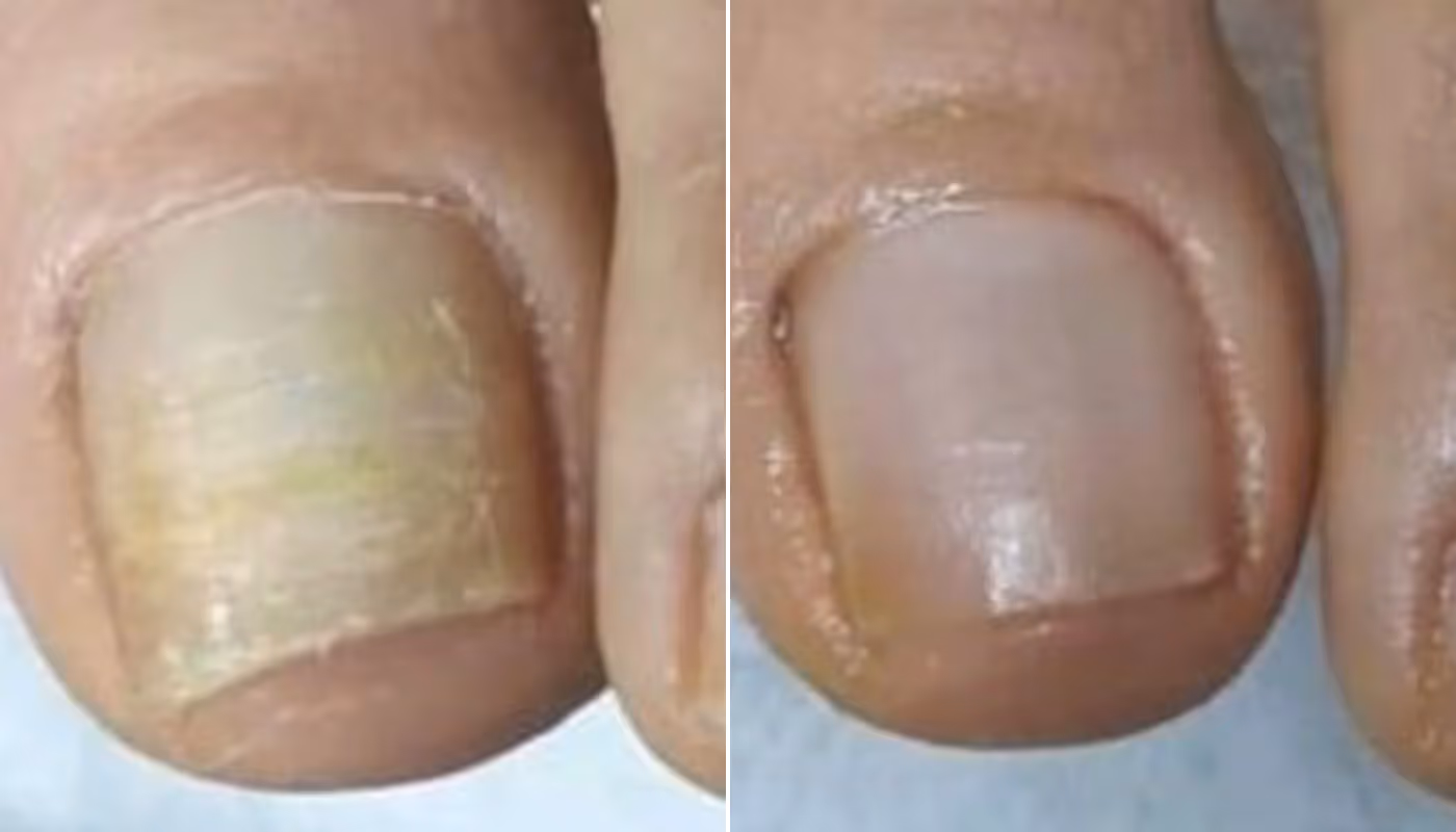 fungus on a nail