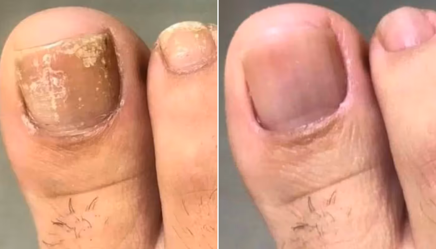 toe nails fungus treatment