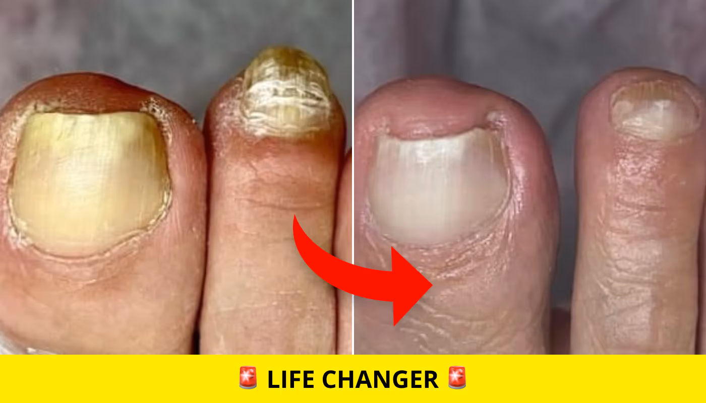 toe nail fungus
